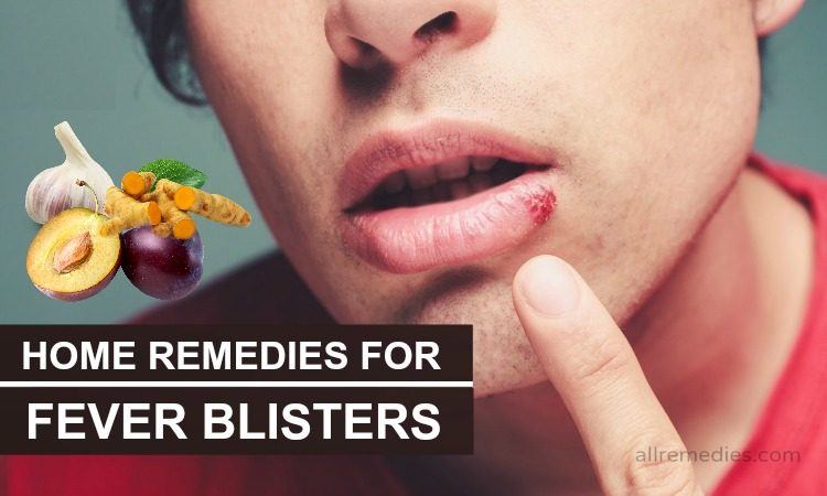 29 Natural Home Remedies For Fever Blisters In Adults 5256