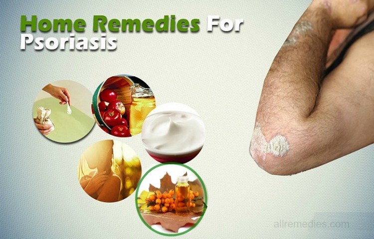 Top 20 Natural Home Remedies For Psoriasis That Work