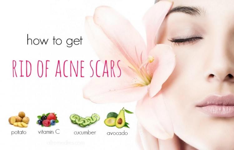38 Tips on How to Get Rid of Acne Scars Fast and Naturally