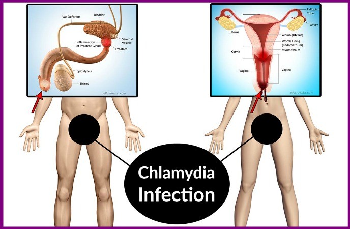 chlamydia-symptoms-and-treatment-healthsoul