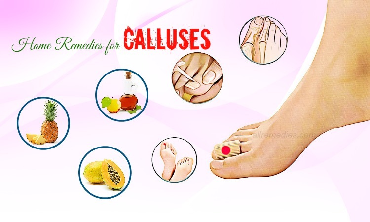 home remedies for calluses