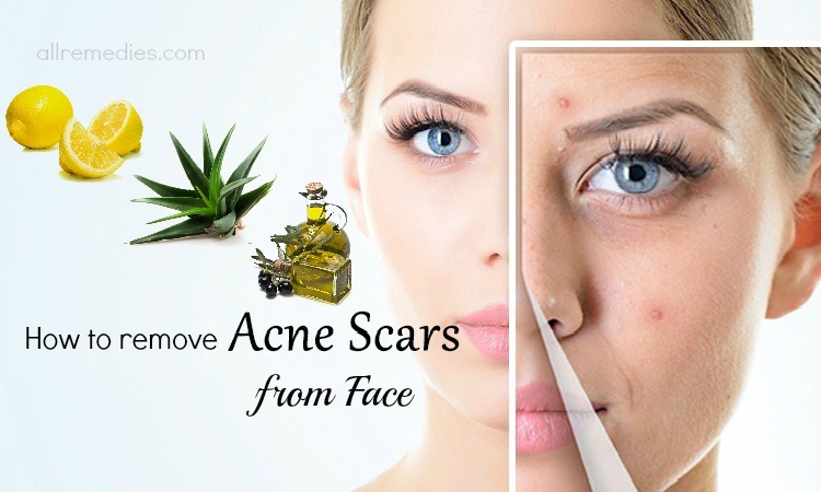 How to remove acne scars from face