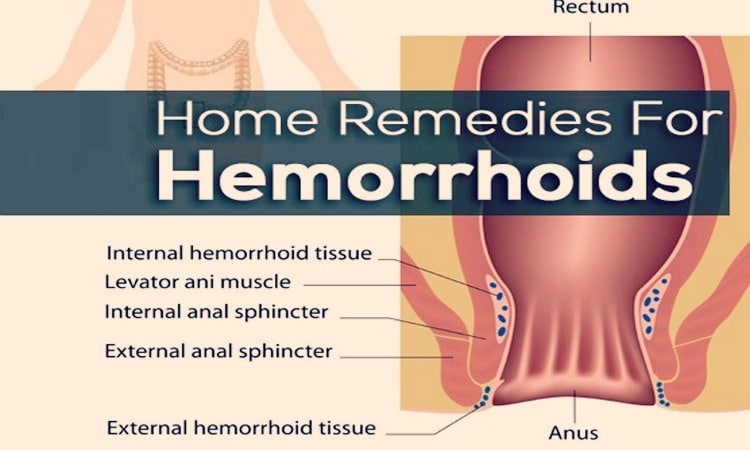 home remedies for hemorrhoids