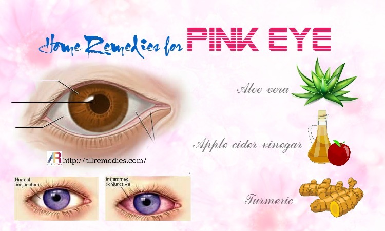 27 At Home Remedies For Pink Eye In Adults 