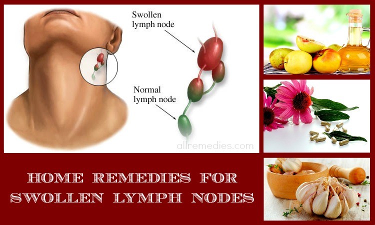 home remedies for swollen lymph nodes