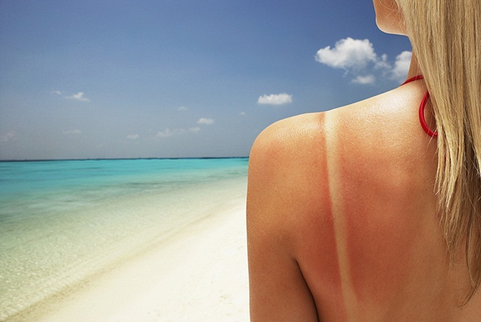 home remedies for sunburn