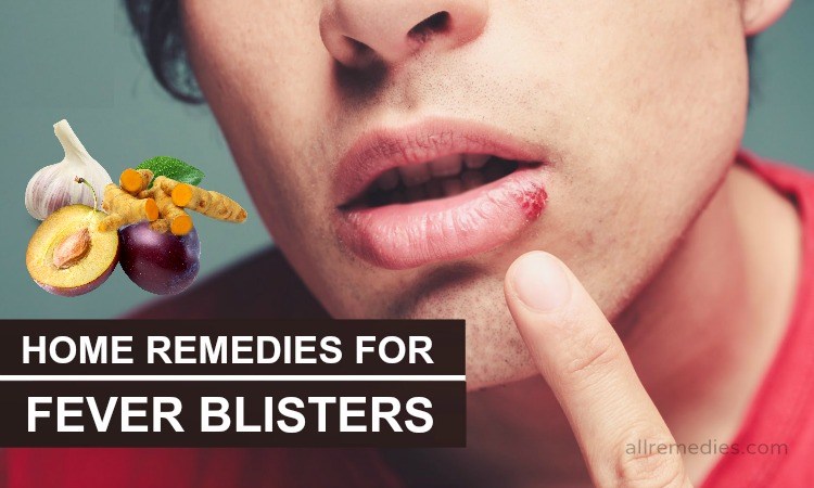 home remedies for fever blisters