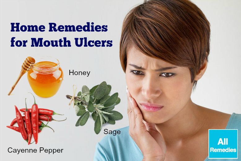 home remedies for mouth ulcers