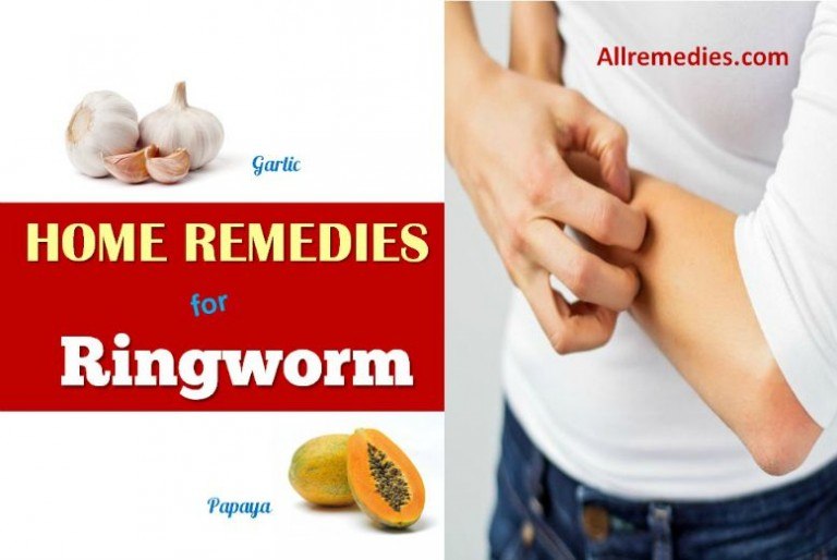 40 Natural Home Remedies For Ringworm In Humans 8597