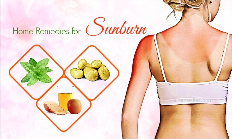 home remedies for sunburn