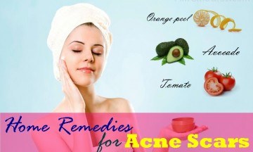 home remedies for acne scars