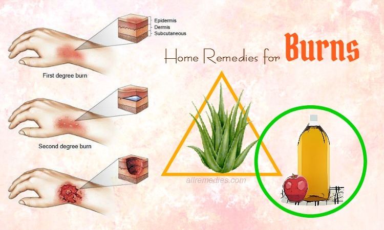 home remedies for burns
