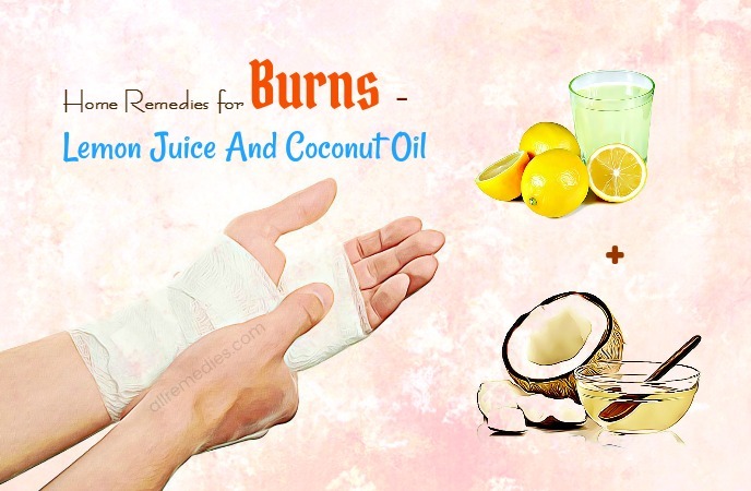 home remedies for burns