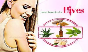 Home Remedies For Hives 1 300x180 