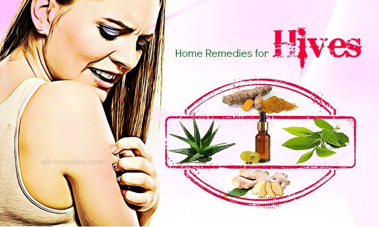 home remedies for hives