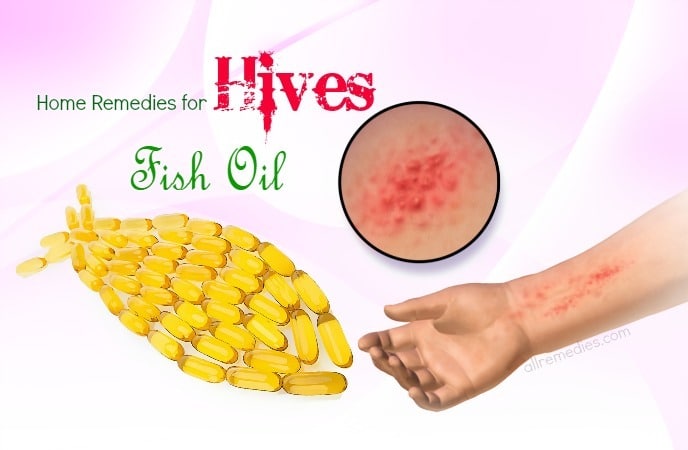 home remedies for hives