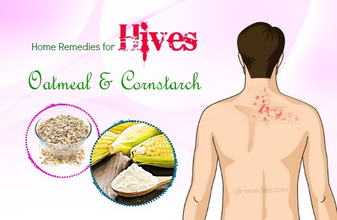 home remedies for hives
