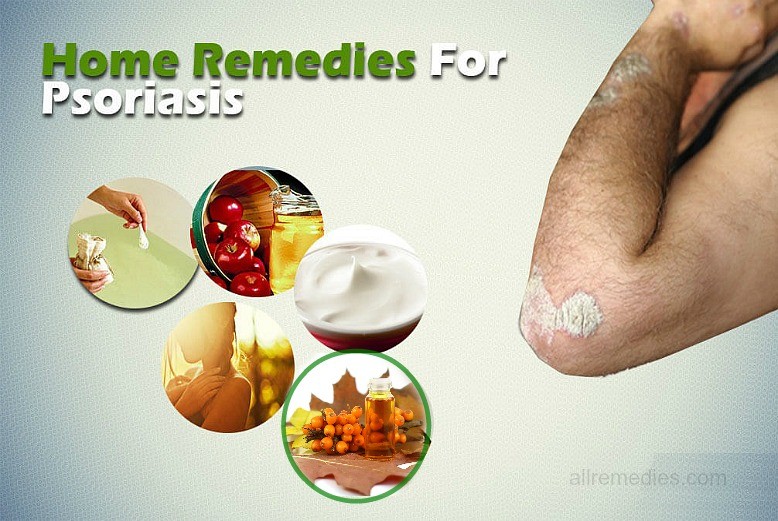 home remedies for psoriasis