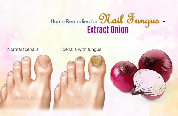 home remedies for nail fungus