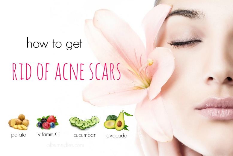 how to get rid of acne scars