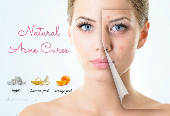 natural acne cures