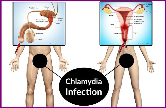 home remedies for chlamydia