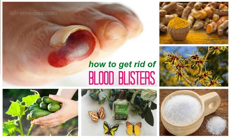 how to get rid of blood blisters