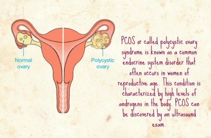 home remedies for PCOS