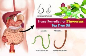 Pinworm Tree 21 Home Remedies For Pinworms: Symptoms, Causes, And Treatments