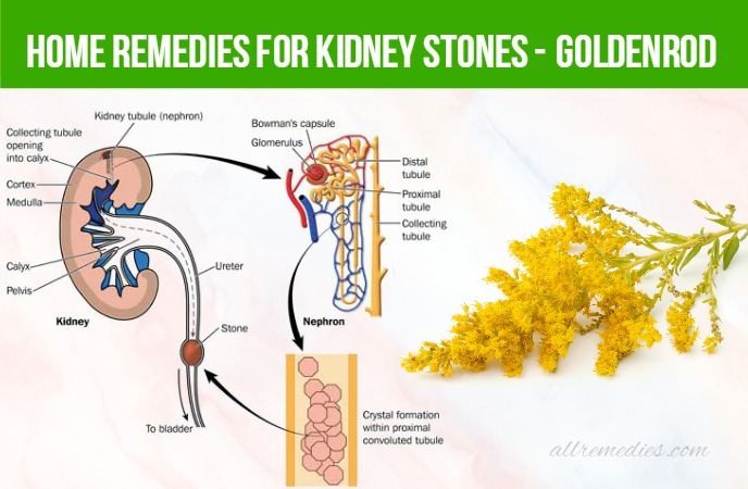 home remedies for kidney stones