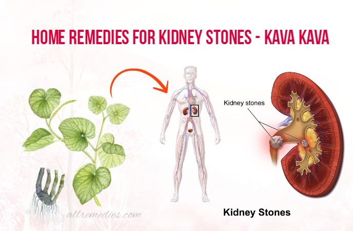 home remedies for kidney stones