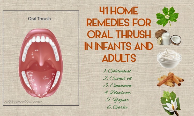 Top 41 Home Remedies For Oral Thrush Causes Symptoms Prevention