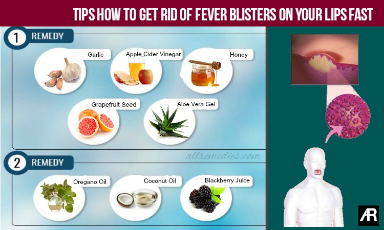 How To Get Rid Of Fever Blister On Lip