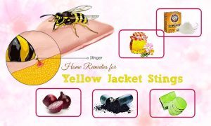 yellow jacket bee sting treatment