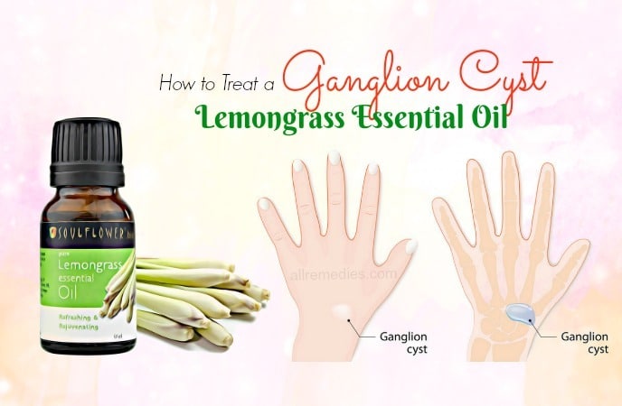 how to treat a ganglion cyst