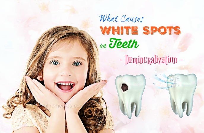 what causes white spots on teeth
