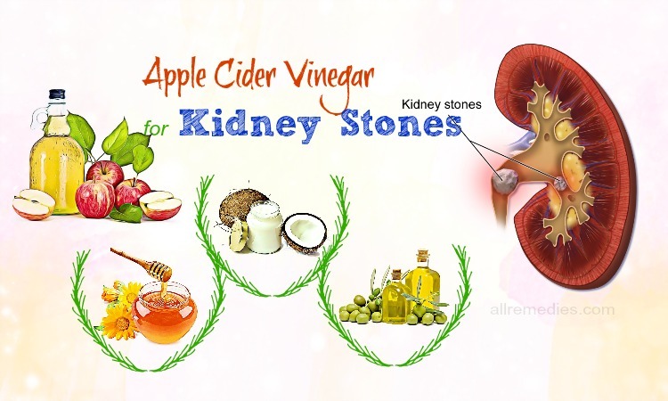 apple cider vinegar for kidney stones