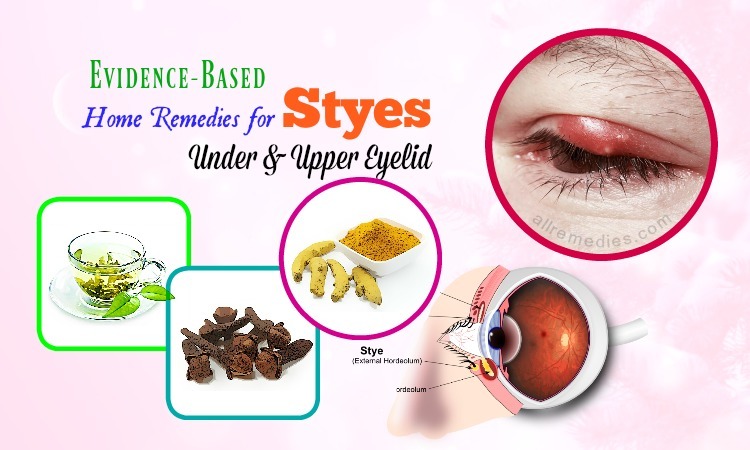 home remedies for styes