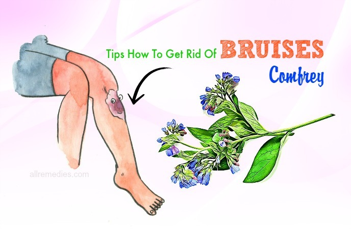 how to get rid of bruises