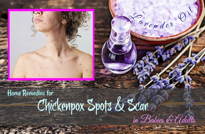 home remedies for chickenpox in adults