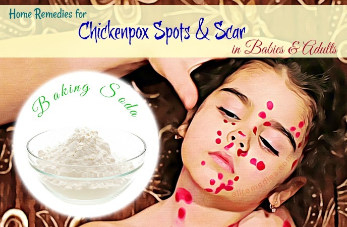 home remedies for chickenpox in babies