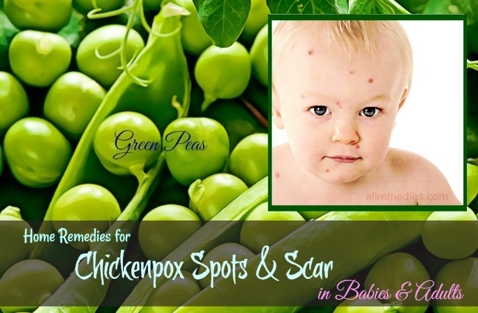 home remedies for chickenpox scar