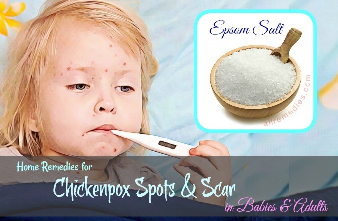home remedies for chickenpox spots