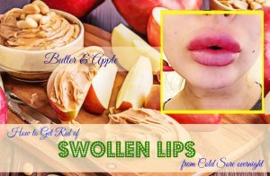 20 Tips How To Get Rid Of Swollen Lips From Cold Sore Overnight