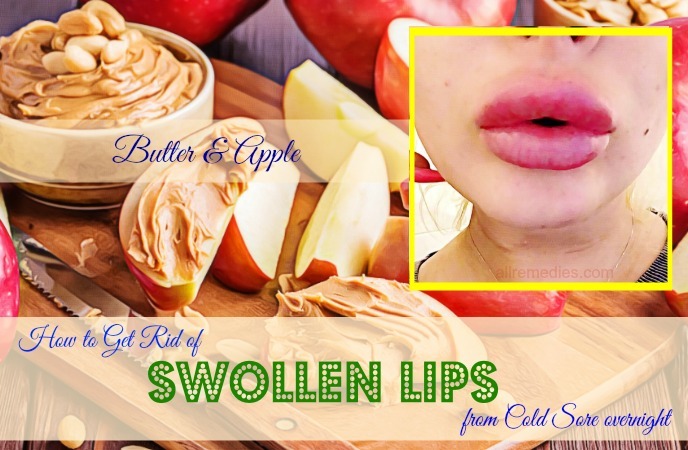 how to get rid of swollen lips from cold sore