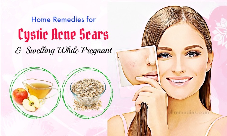 home remedies for cystic acne