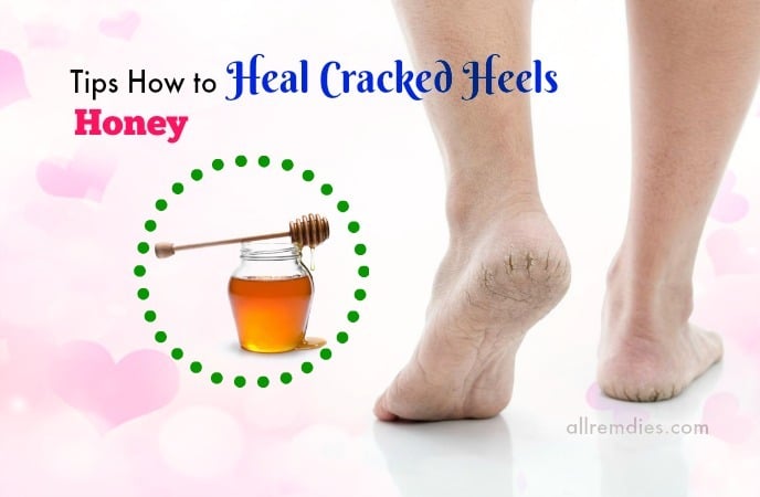 how to heal cracked heels and feet