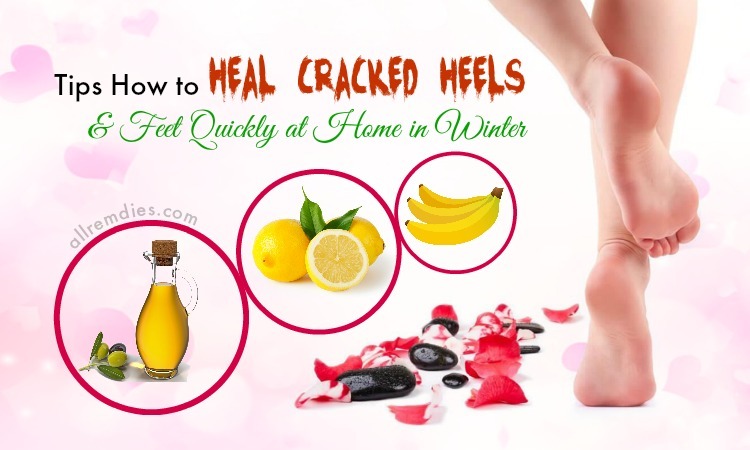 how to heal cracked heels