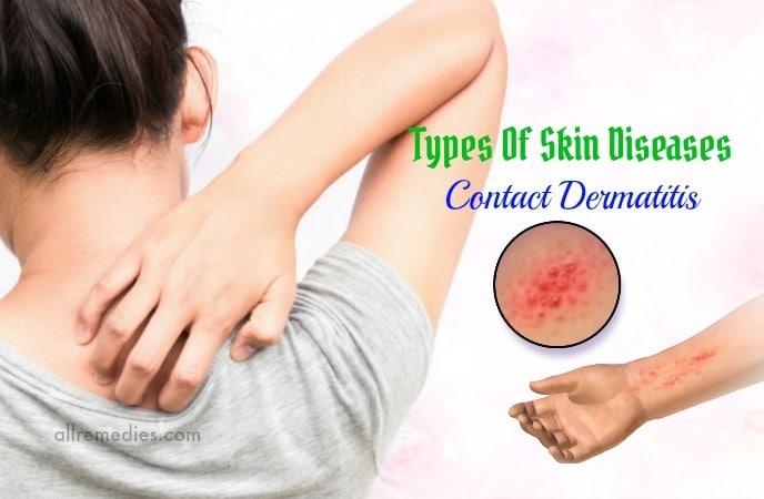 types of skin diseases
