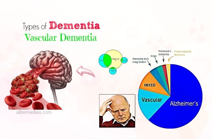 List Of 17 Common Types Of Dementia And Early Symptoms